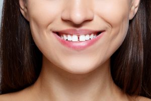 Dental Gaps 2 Ways To Close Them