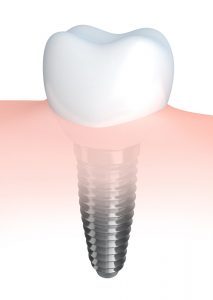 dentalimplnatsingletissue